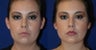 Liposuction of neck with chin implant