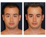 Chin Implant