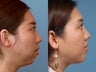 Chin Augmentation