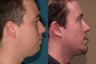 Chin Augmentation