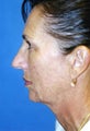 Chin Implant