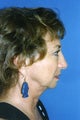 Chin Implant