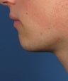 Chin Implant