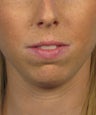 Chin Implant