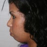 Chin Implant