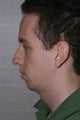 Chin Implant