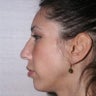 Chin Implant