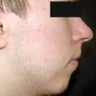 Chin Implant