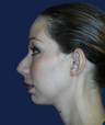 chin implant