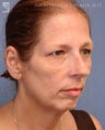 Chin Implant