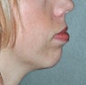 Chin Osteotomy