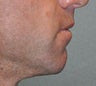 Chin Augmentation