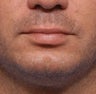 Chin Augmentation
