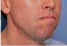 Jawline Augmentation