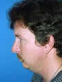 Chin Implant Procedure