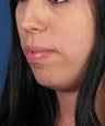 Chin Implant