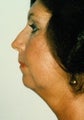 Chin Augmentation