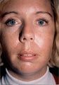 Chin Augmentation
