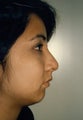 Chin Augmentation