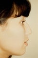 Chin augmentation