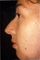 Chin Augmentation