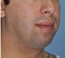 Chin and Jaw Angle Implants