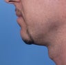 Chin Augmentation