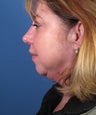 Chin Implant