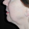 Chin Augmentation