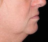 Chin Augmentation