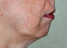 Chin Augmentation