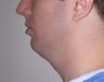 Chin Implant with neck liposuction