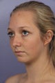 Chin Augmentation and Liposuction of the Neck