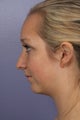 Chin Augmentation and Liposuction of the Neck