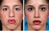 Rhinoplasty and Chin Implant