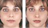 Rhinoplasty with chin implant front view