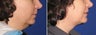 Chin / Neck Liposuction