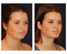 Chin Lipo