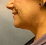 chin liposuction