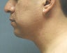 chin liposuction