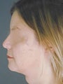 Chin Liposuction