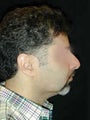 Chin / Neck Liposuction