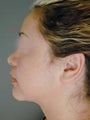 Chin / Neck Liposuction
