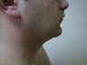 Liposuction of neck/chin area