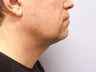 Chin/Neck Liposuction