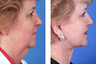 Complete facial plastic surgery, age 56