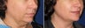 Chin / Neck Liposuction