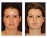 Chin Lipo