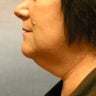 chin liposuction