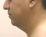 chin liposuction